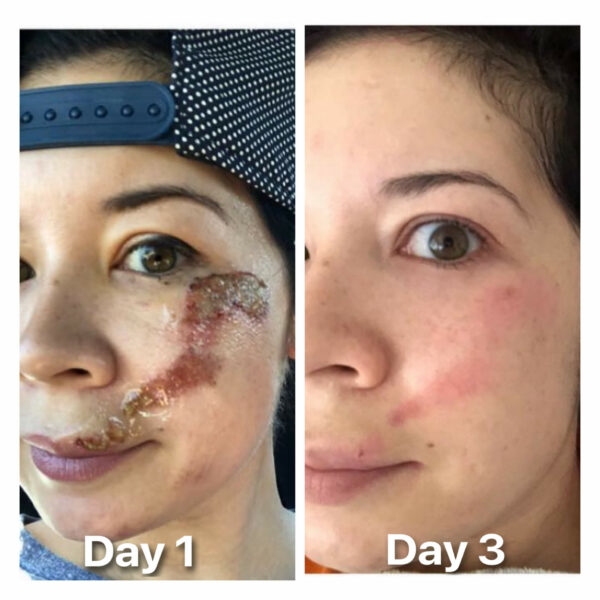 Before And After 3 Days of Luzern Serum The Replenishing Oil - Waters Aesthetics in Phoenix, AZ